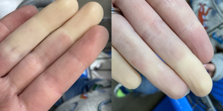 This is what Rachel Smith's hands looked like during a trip to the grocery store. \"My body is hyper-sensitive to cold,\" she said.