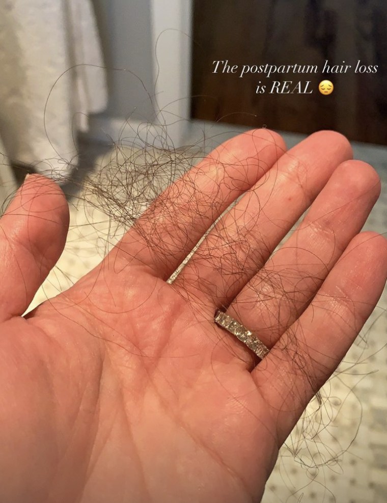 Lea Michele shares photo of postpartum hair loss