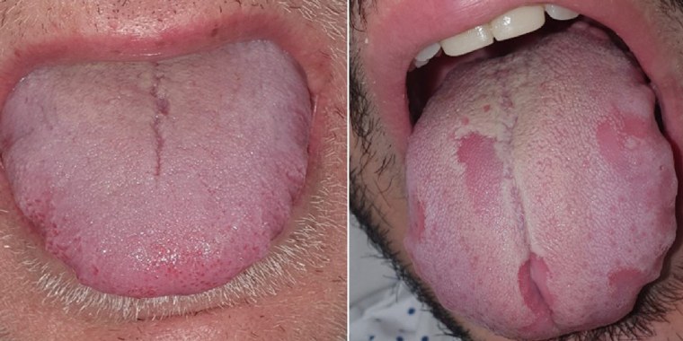 Signs of "COVID tongue" include inflammation of the small bumps on the tongue's surface, a swollen and inflamed tongue, or indentations on the side. (© British Association of Dermatologists/John Wiley &amp; Sons, Inc.)