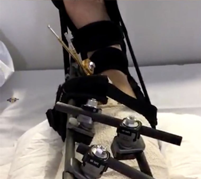 Doctors put Judd's broken leg in an external fixator after the accident.