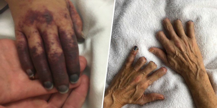 Grainger's hands became purple, but doctors were able to save them. Seven of her fingertips had to be amputated.
