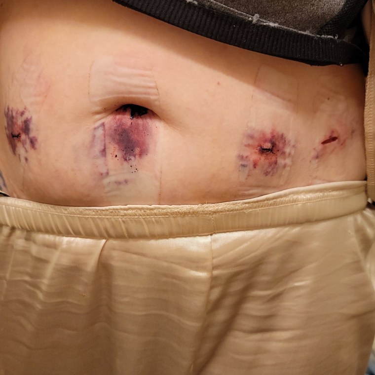 This is What Endometriosis Surgery Looks Like When a Blood - MEDizzy