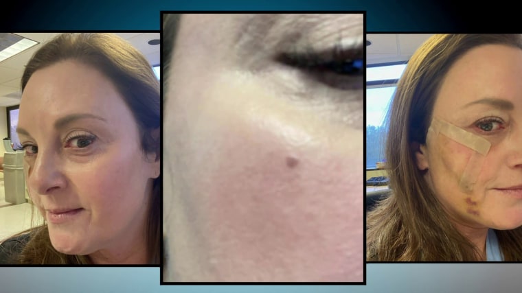 Dr. Jill Hechtman developed a small freckle-like blemish on her face about six months ago that later turned out to be skin cancer.