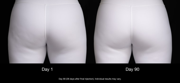 Cellulite treatment Qwo gets rid of cellulite with injection