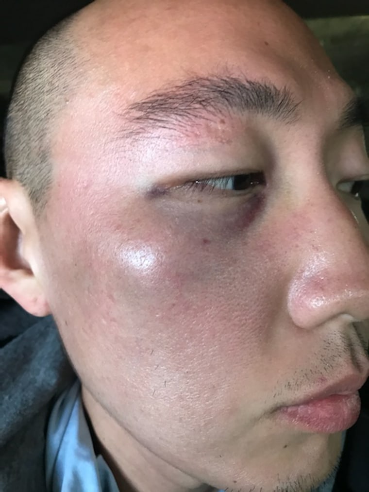 After Kim checked into the hospital, he found out he'd suffered a fracture on the right side of his nose. He also had a black eye and forehead bruises.