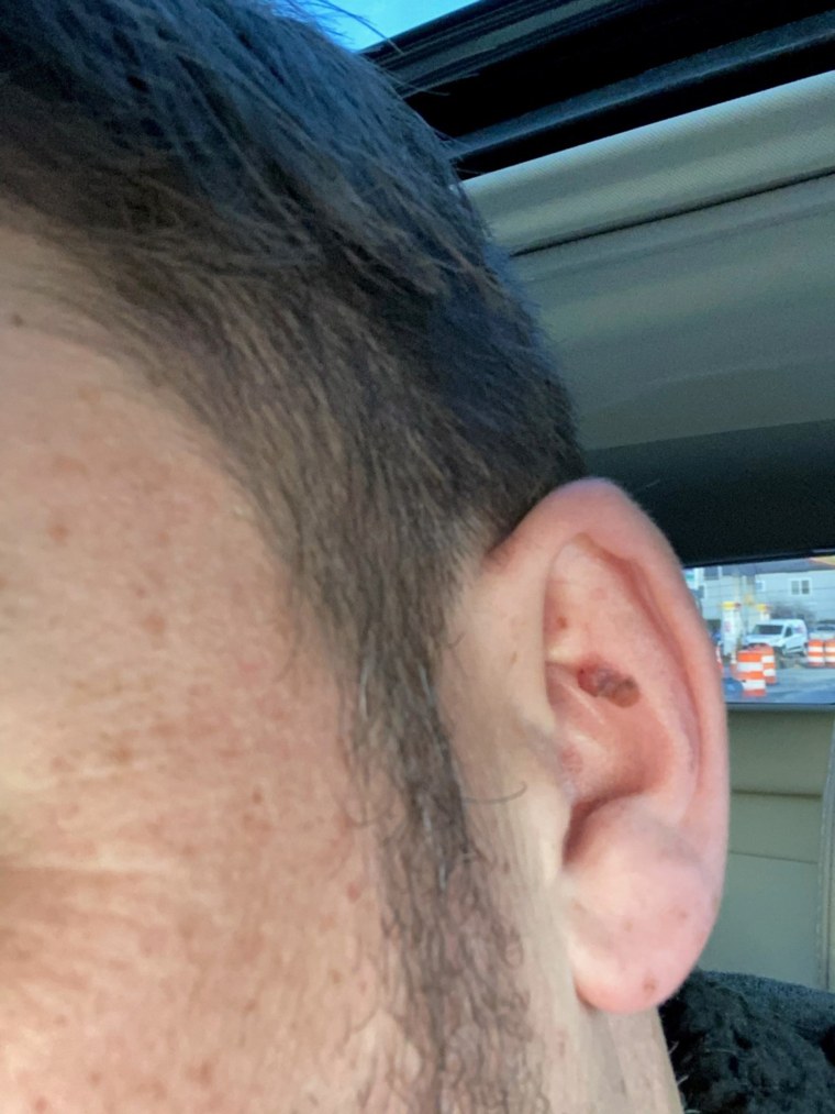 Skin Cancer Man With Ear Melanoma Shares Warning Signs