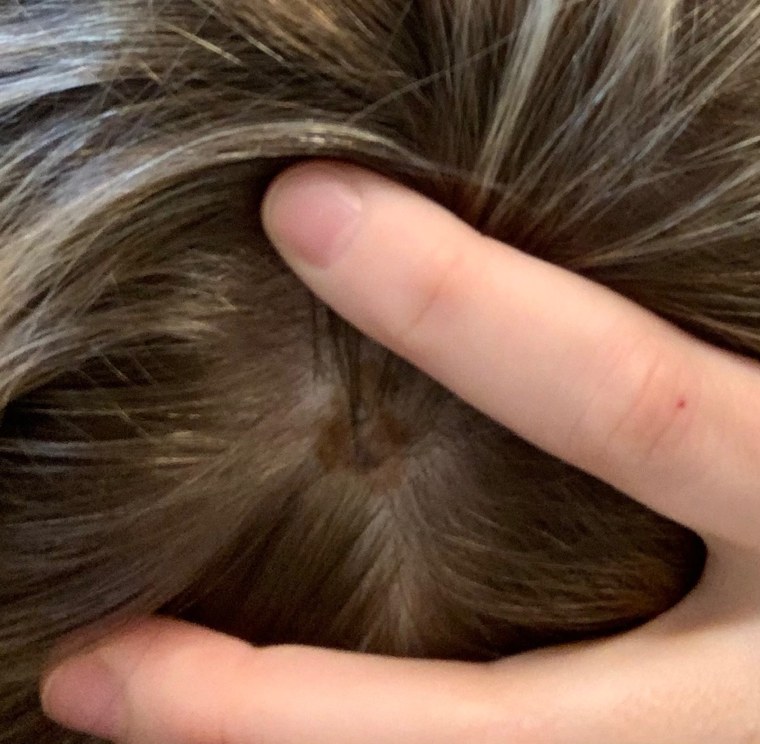 The spot on the top of Caitlin Jones' head had been biopsied in 2016, but was not concerning at the time. It suddenly started growing last year.