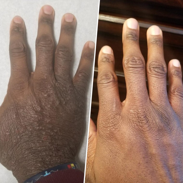 After having eczema for his entire life, Kwame Baird felt skeptical that participating in a clinical trial would help his skin. But after three months of taking upadacitinib, he noticed the dryness and itchiness had gone away. 