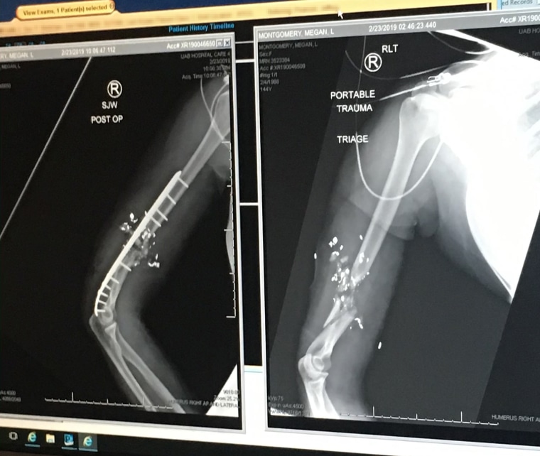 X-rays show the damage to Megan Montgomery's upper right arm from when she was shot in February 2019 and the surgery to repair it.