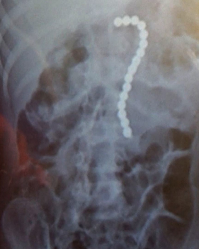 Two year old Konin Arrington was hospitalized after swallowing 16 magnetic balls