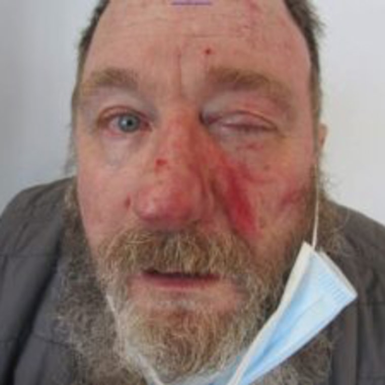 Image: Mark Dinning injured in a fight.