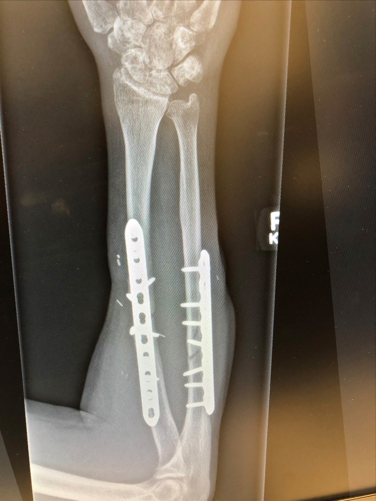 According to Dr. Desai, both bones in Kieffer's arm were broken and in addition to plates and screws to hold them in place, bone had to be taken from Keiffer's hip to help his radius heal.