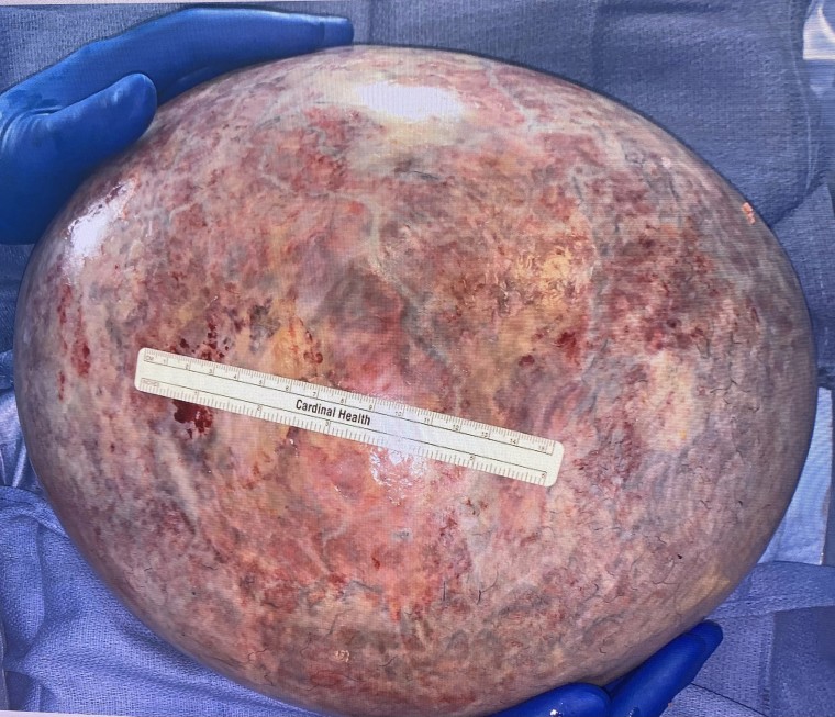 The ovarian cyst weighed about 13 pounds and was 30 centimeters across. 