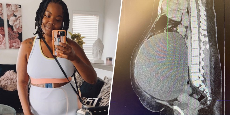 Chante Burkett first started experiencing symptoms of her ovarian cyst in December 2020.