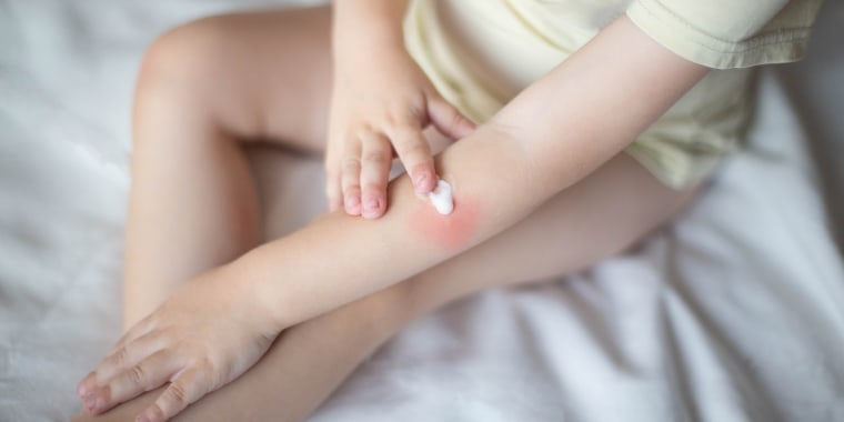 A small child smears redness on the hand with baby cream. The concept of treatment and skin care with a cream, rash and peeling in children, dermatology