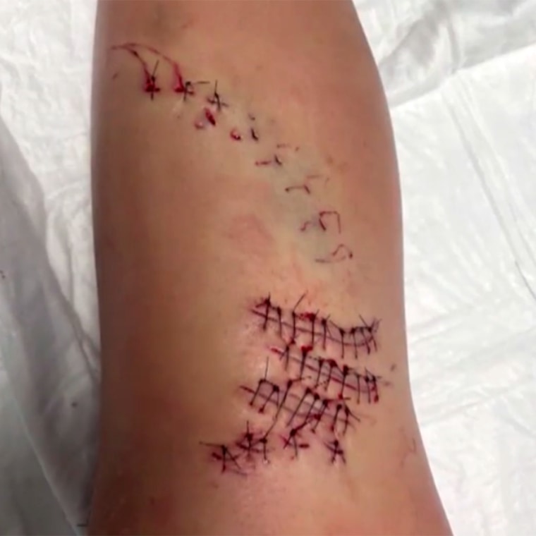  Jordan Prushinski, 12 ans, a reçu 42 points de suture après qu'un requin l'a mordue près des rives d'une plage du Maryland.