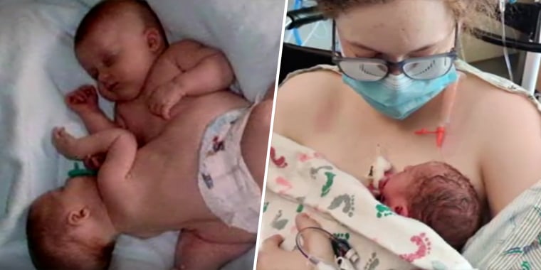 Twenty-one years after Charity Lincoln Gutierrez-Vazquez and her sister Kathleen were born as conjoined twins, Charity gave birth to her own daughter at the same Seattle hospital. 