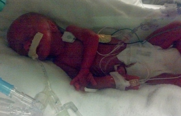 An infection Emma had when she was a preemie caused bilateral paralyzed vocal cords and she has needed to use a tracheostomy tube to breathe.