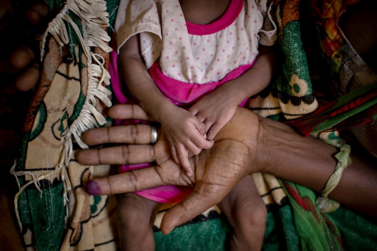 A mother holds the hands of her malnourished daughter at a medical clinic in the town of Abi Adi, in the Tigray region of northern Ethiopia in May. 