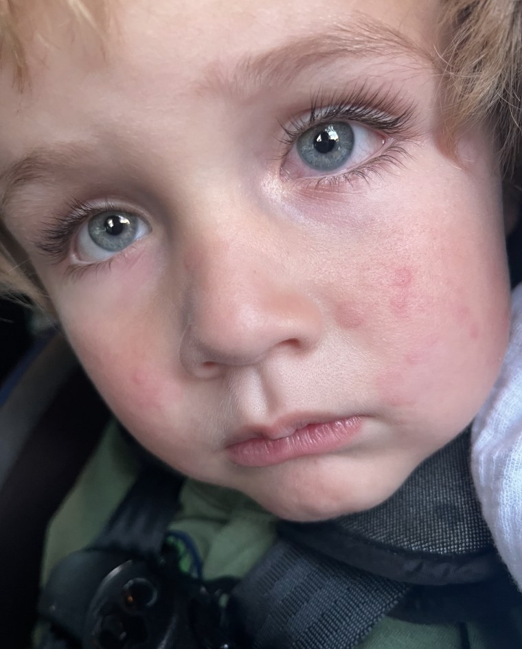 Heather Fisher told TODAY her 3-year-old son, Griffin, suffered head to toe hives after bathing.