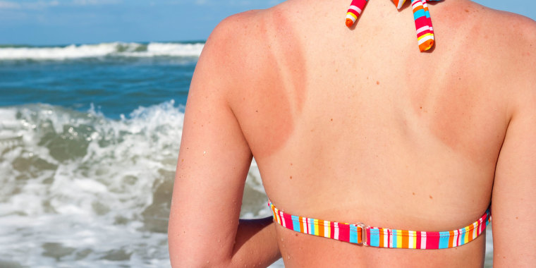 Sunburn pattern on back of young woman at the beach