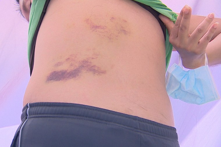 Berta shows the bruises on her body.