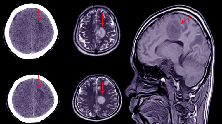 Una tomografía que muestra una lesión cerebral.