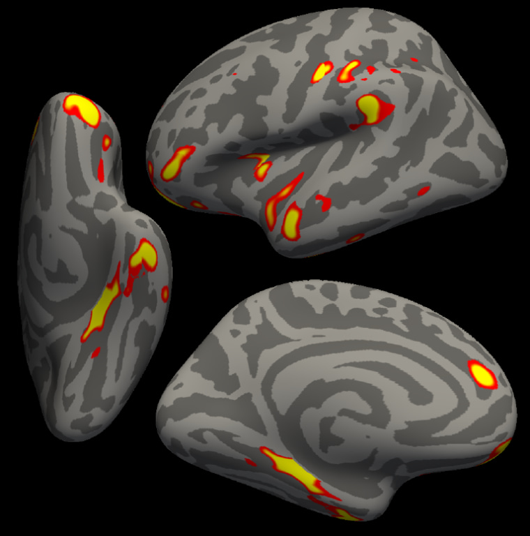 The red-yellow regions are the parts of the brain that shrink the most in the 401 SARS-CoV-2 infected participants