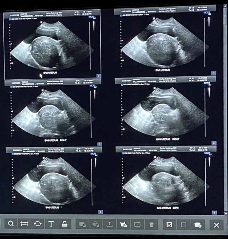 Cynthia Talla’s ultrasound showing uterine fibroids.