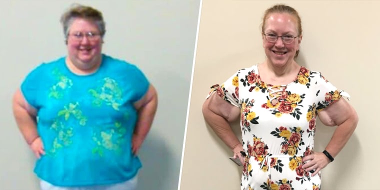 Sheryl Bader before and after her weight loss. She considers her bariatric surgery a life-saving option that helped her regain control of her health.