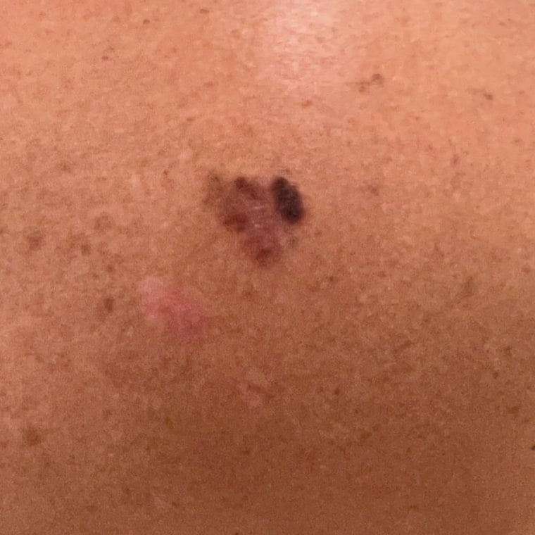 Mellencamp shared this photo of her suspected melanoma. 