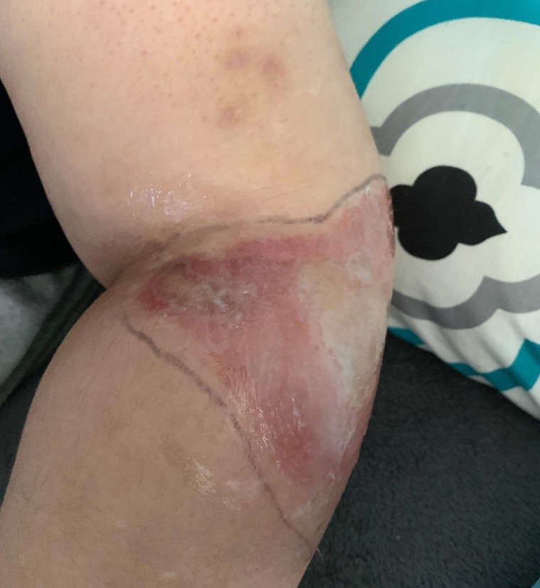 When Kaylan Wilhelm underwent chemotherapy she experienced an uncommon problem where the medication infused into her tissue instead of going into her vein. She suffered an open sore from it that led to scarring.