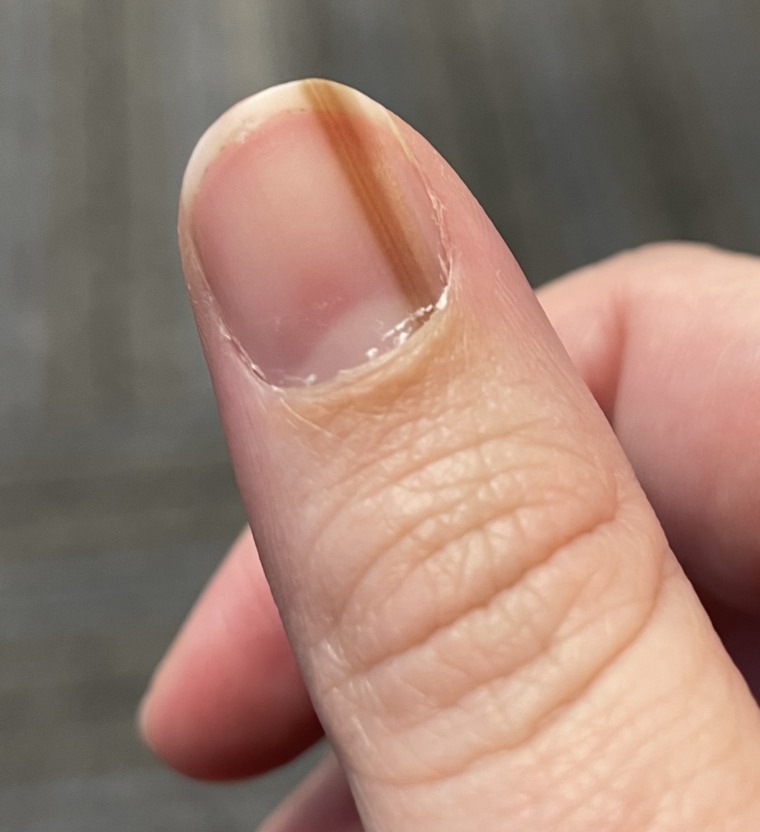 Over the years, the tan streak on Maria Sylvia's nail became darker, but doctors suspected it was just a mole.