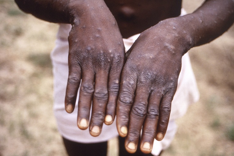 A young patient shows his hands which appear to be in the recuperative stage of monkeypox, in the Democratic Republic of the Congo, in 1997.