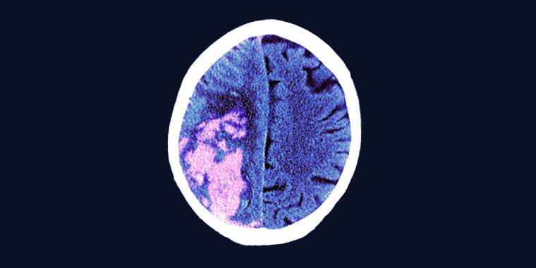 Magnetic resonance imaging scan of an axial section through the brain of an 80-year-old male patient following a stroke.