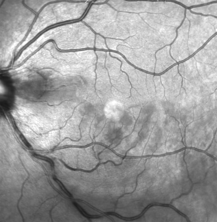 Are eye floaters a symptom of stroke