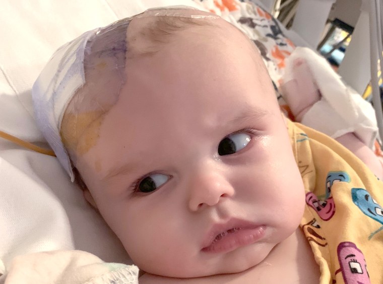 Mom Melissa Moro thought baby Luca's head was too big. It had become swollen because he had a golf-ball sized benign tumor.