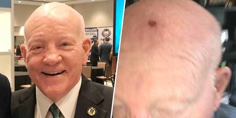 Vincent Boles has learned how to use makeup to conceal the scar on his scalp, “but it does look like a divot has been taken out of my head,” he said. The cancerous spot, seen on the right before it was removed, showed up last year and began growing rapidly.