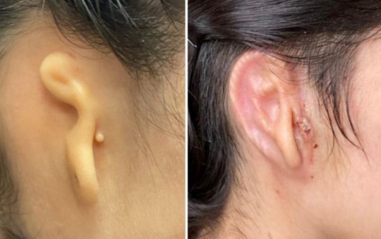 Patient's ear before surgery, left, and patient's ear 30 days post surgery.  