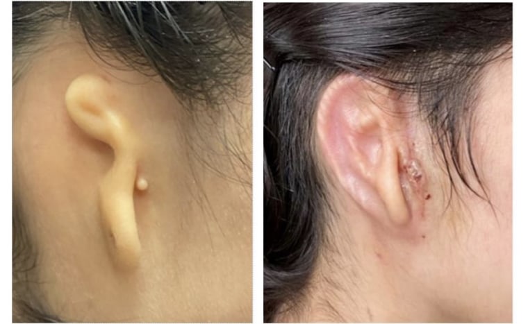 El antes y el después de la oreja de Alexa, la mujer mexicana que recibió un trasplante hecho con una impresora en 3D.