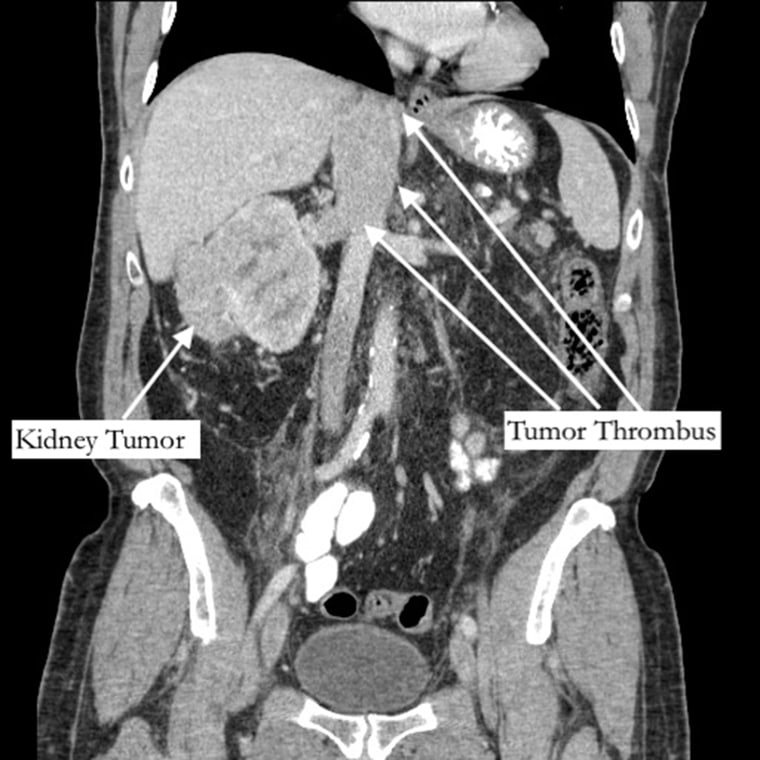 The kidney tumor blocked the vena cava, meaning that the blood couldn't flow from the lower half of Richard Bernstein's body to his heart.