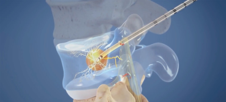 The Intracept procedure involves heating the nerve root in the area causing the pain to prevent it from sending pain signals to the spinal cord and brain.