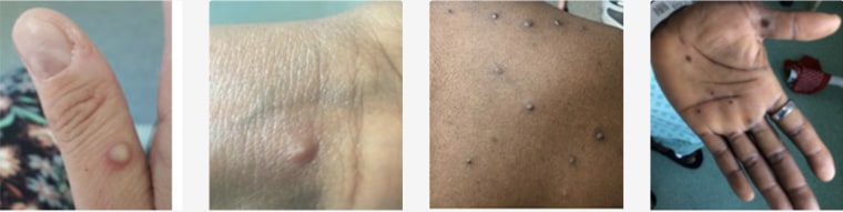 monkeypox pictures