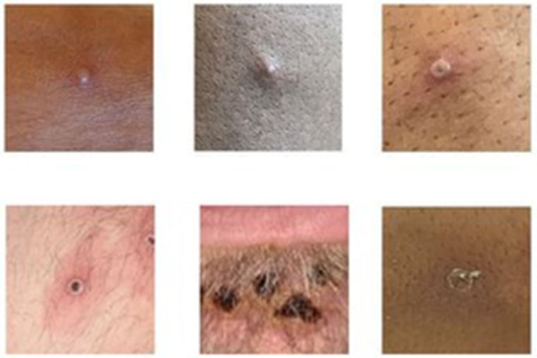 Pictures of monkeypox symptoms and rash from UK Health Security Agency.