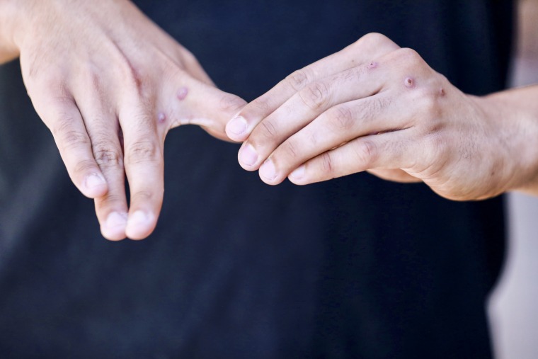 Image: Gerald Febles shows monkepox lesions on his hands on July 3, 2022 in New York.