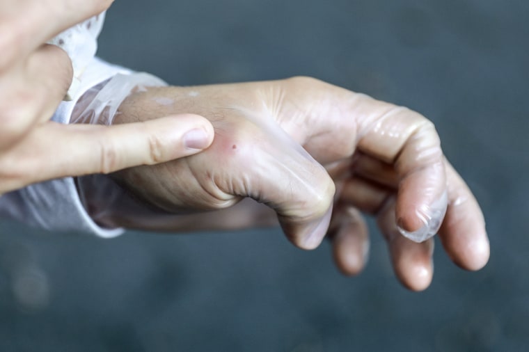 Luke Brown points to a monkeypox lesion on the knuckle of his thumb.