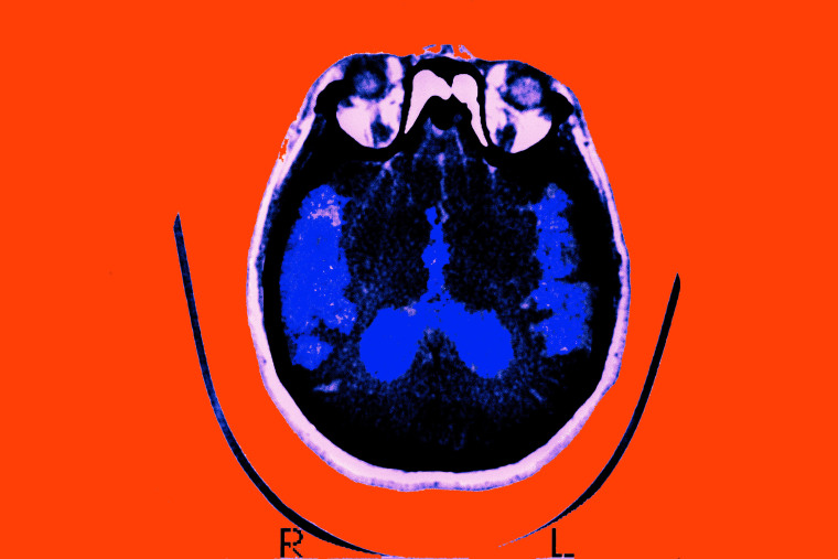Escáner del cerebro de un paciente afectado por la enfermedad de Alzheimer Sección axial.