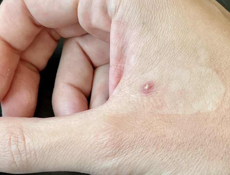 Monkeypox sore on Jack Richards' hand.
