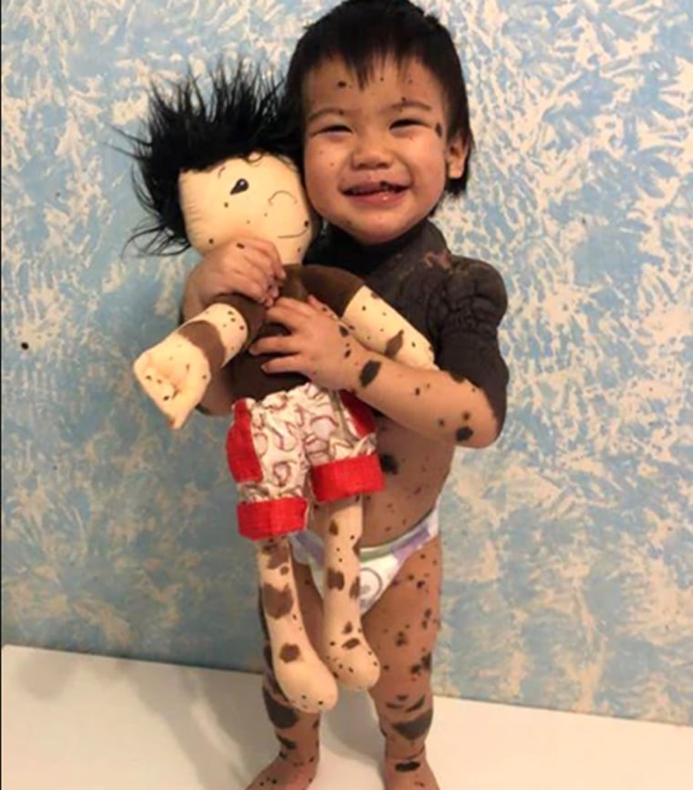 Keegan nació con lunares esparcidos por todo el cuerpo. Su mamá se refiere a él como su "chispa de chocolate" y le encanta tener un muñeco tan único como él.
