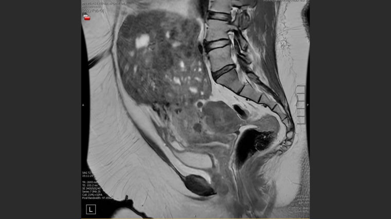 Los fibromas pueden crecer rápida y masivamente.